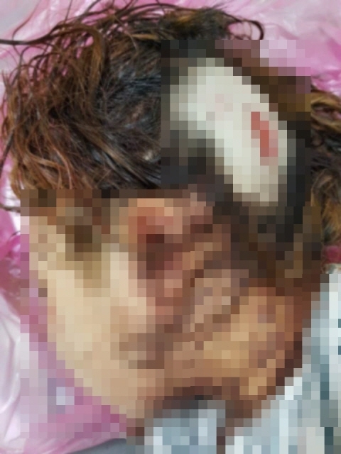 ▲ 지난 1일 또래 여중생들에게 1시간 30분 동안 폭행당해 머리 뒤쪽이 찢어져 치료를 받고 있는 피해 여학생 모습. ⓒSNS 캡처