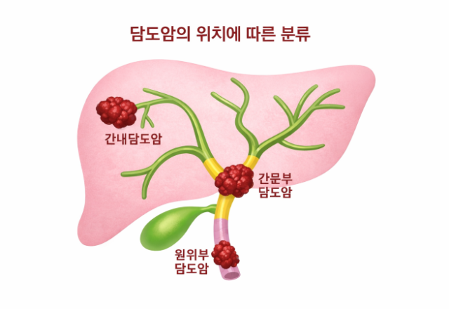 담도암, 피부·눈 노래지거나 소변 색 짙어지면 검사 바람직 - 뉴스 썸네일 이미지